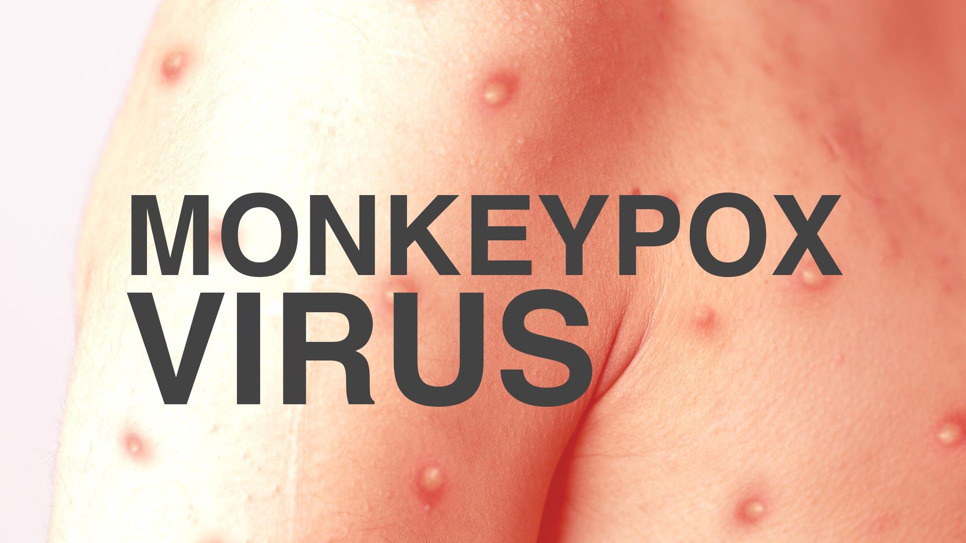 monkeypox virus advisory raffles medical group