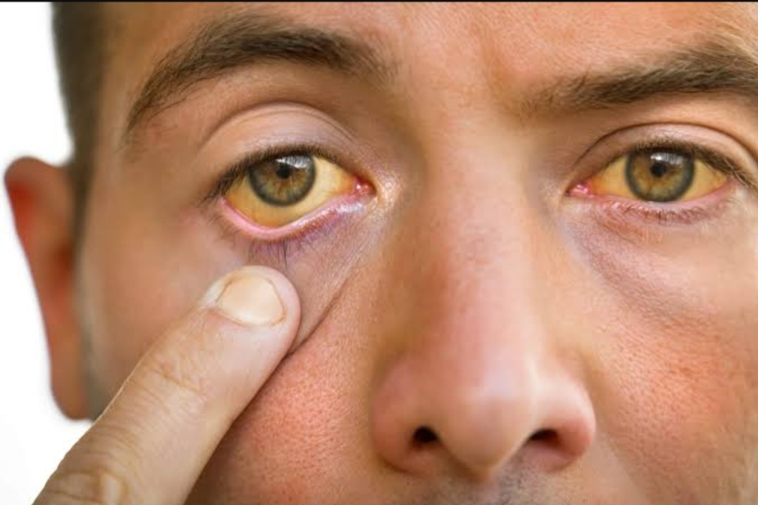 भारत हुआ ट्रैकोमा-मुक्त, जेपी नड्डा ने सरकार के 11 साल की गिनवायीं उपलब्धियां